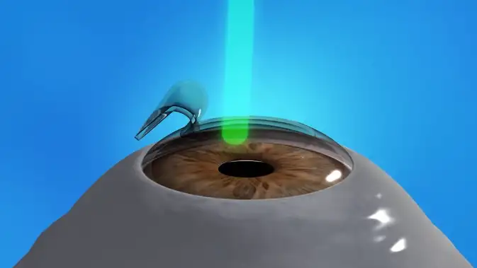 ATOS Lasik