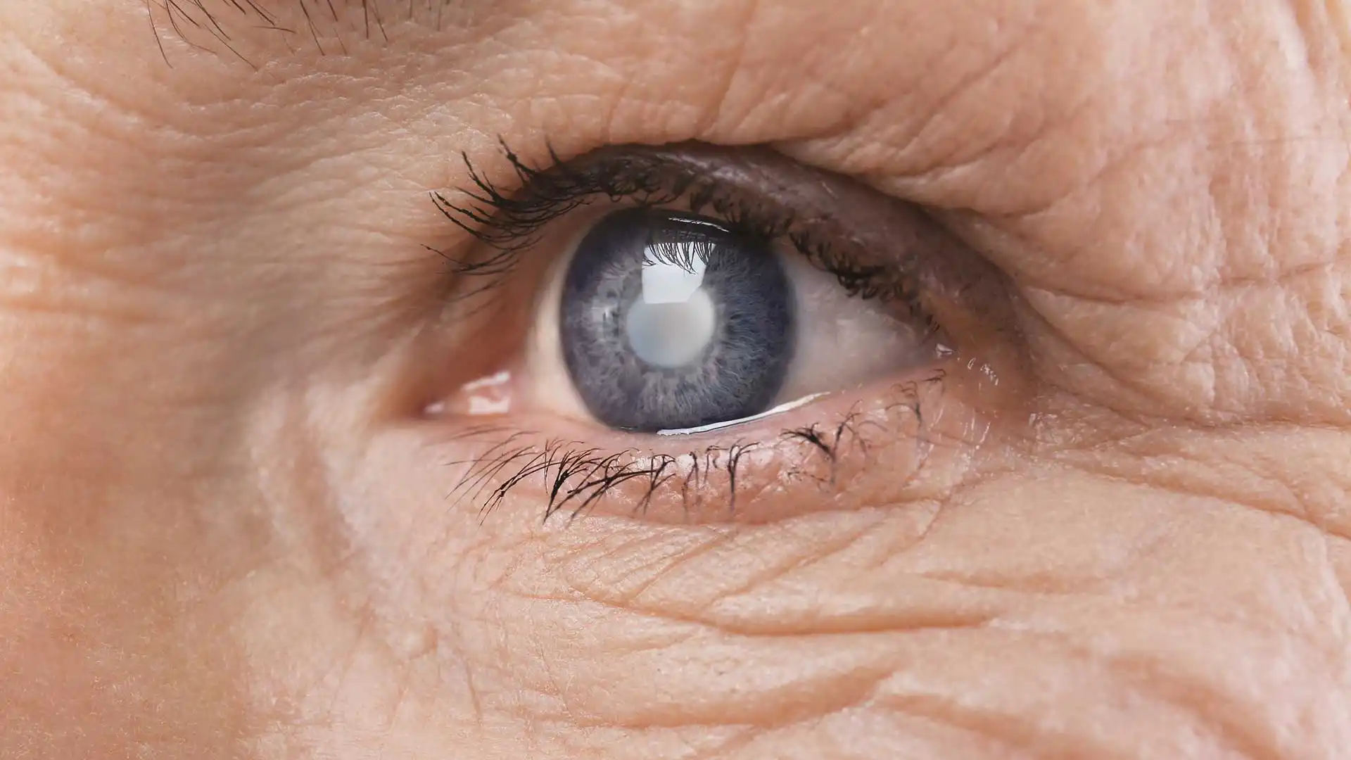 Cataract Surgery in Gangnam, Korea (2026 Guide): Costs, Lens Options, Recovery, and Why International Patients Choose Gangnam